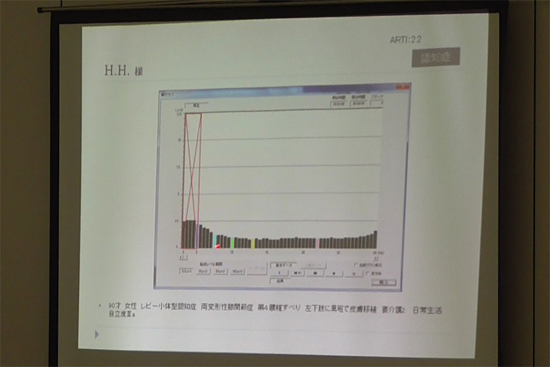 「パルラックスプロ」認知症被験者の脳波グラフ